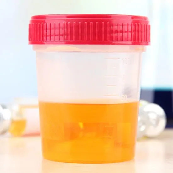 catecholamines fractionated random urine